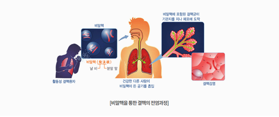 [비말핵을 통한 결핵의 전염과정]활동성 결핵환자-비말핵(날 비,분말 말)-건강한 다른사람이 비말핵이 든 공기를 흡입-비말핵에 포함된 결핵균이 기관지를 지나 페포에 도착-결핵감염